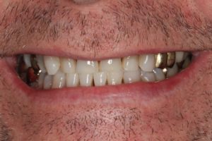 Severe tooth wear of the front teeth