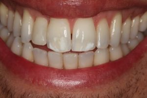 white areas on the front central teeth which affects confidence in smiling