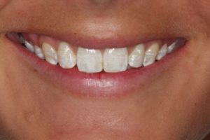 woman smiling with one front tooth back in line