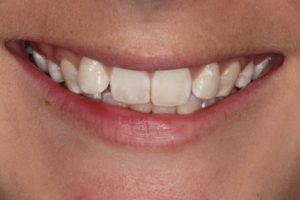 woman smiling with one front tooth sticking outwards