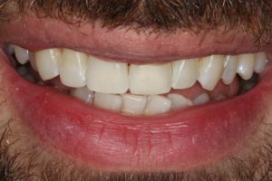 after social 6 lingual brace, teeth whitening & composite bonding treatment