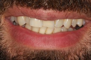 before social 6 lingual brace, teeth whitening & composite bonding treatment