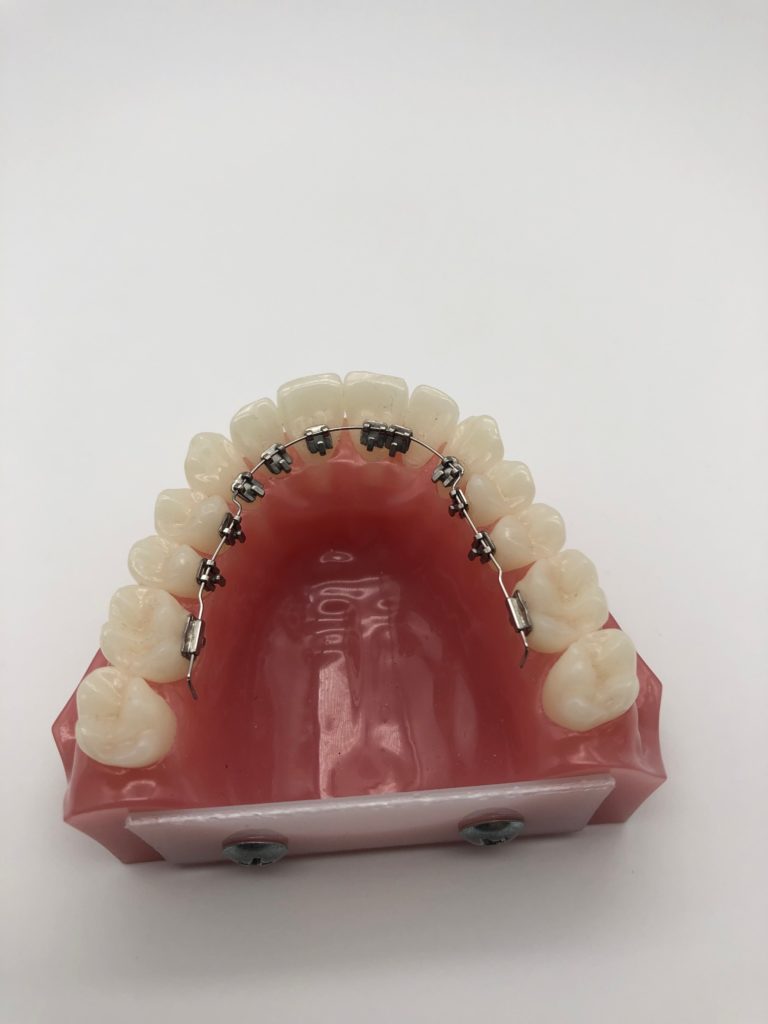 teeth model showing several brackets have come off the teeth