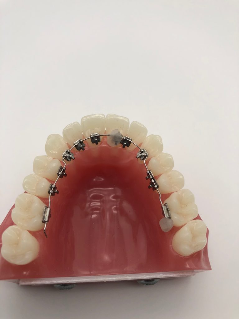 wax on the central tooth bracket holding it in place