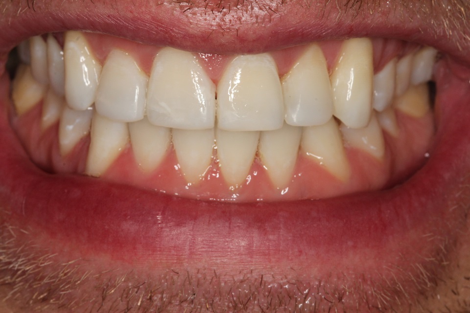 a great new smile within just a few months using minimally invasive dentistry
