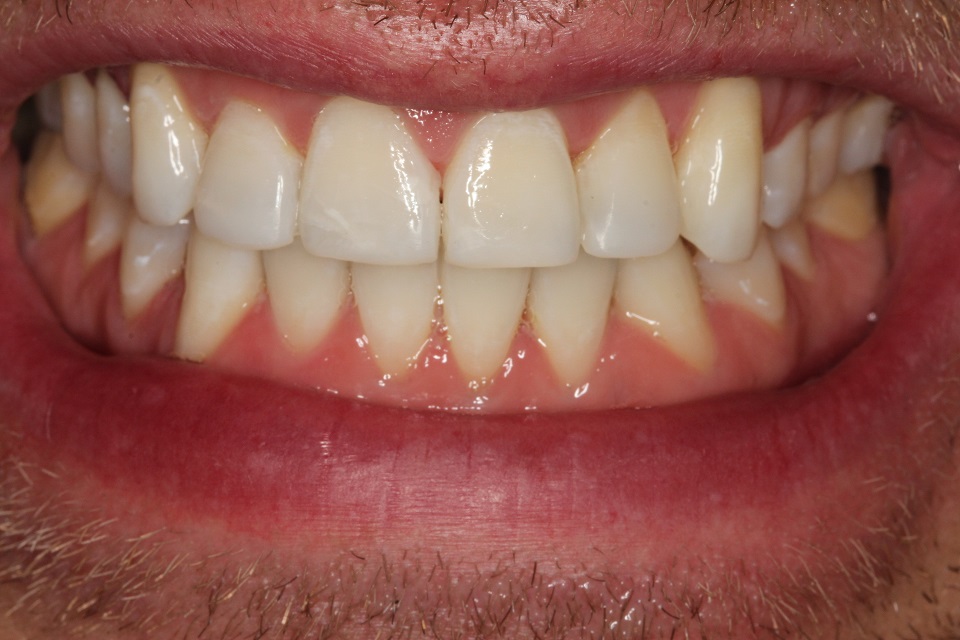 a great new smile within just a few months using minimally invasive dentistry