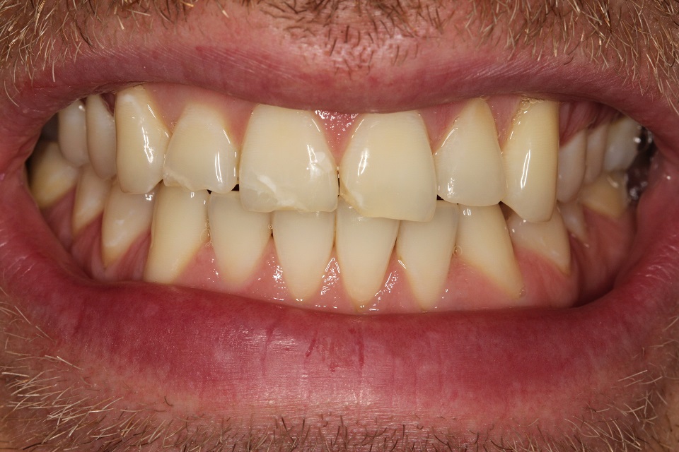 crowding of both the upper & lower front teeth, quite severe wear & tear, & discolouration