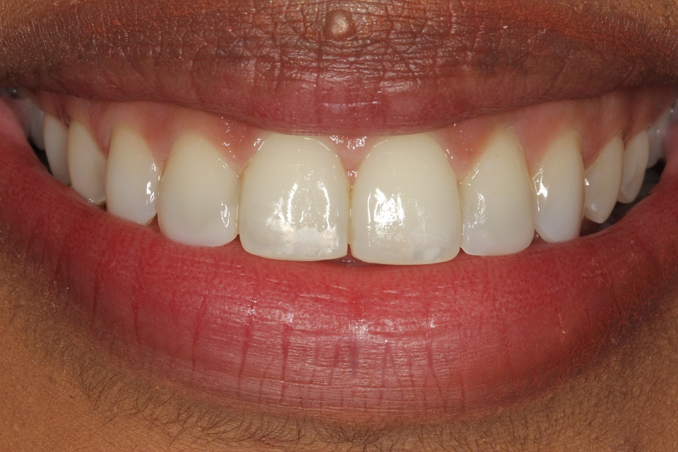 after composite bonding & lingual braces treatment for front teeth