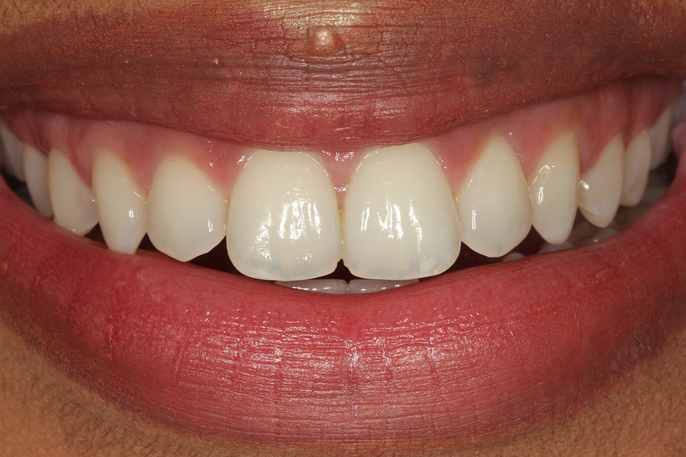 before composite bonding & lingual braces treatment for front teeth