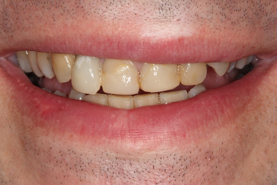 before photos of teeth with ceramic crown treatment