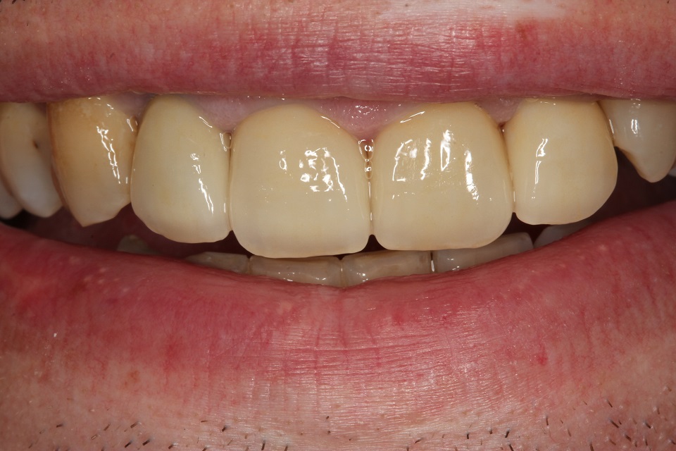 after photos of teeth with ceramic crown treatment