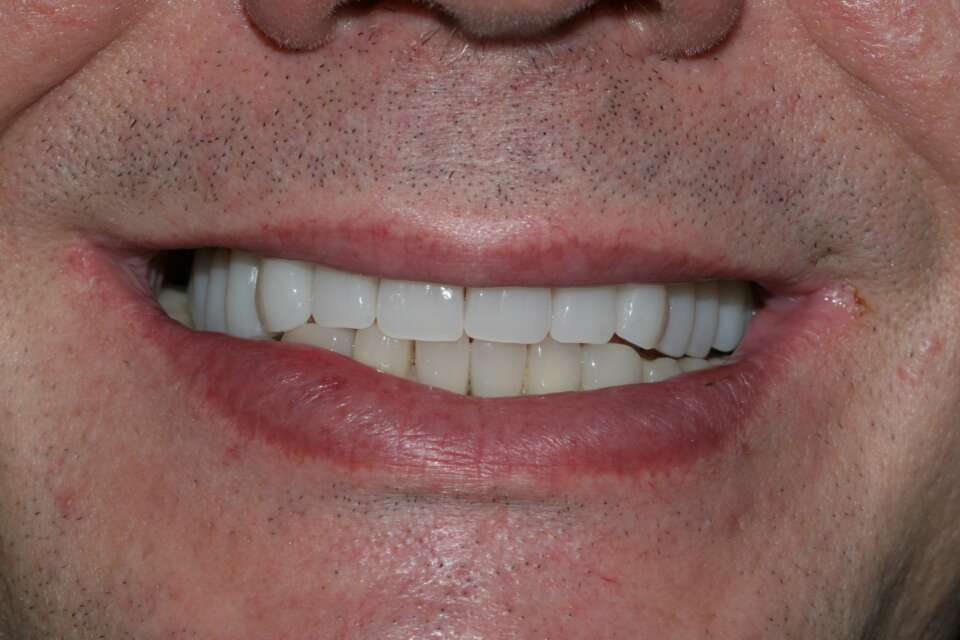 All teeth implants After 5