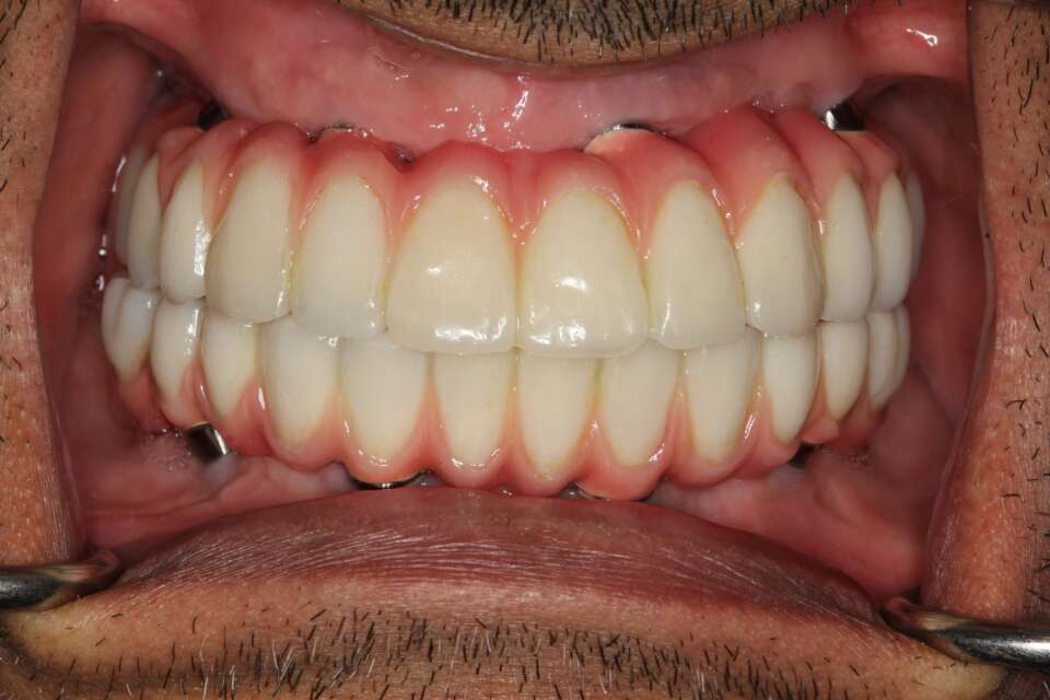 All teeth implants After 1