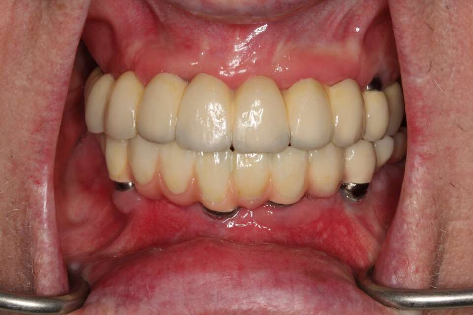 All teeth implants After 2