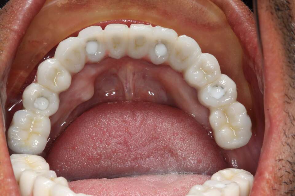 All teeth implants After 3