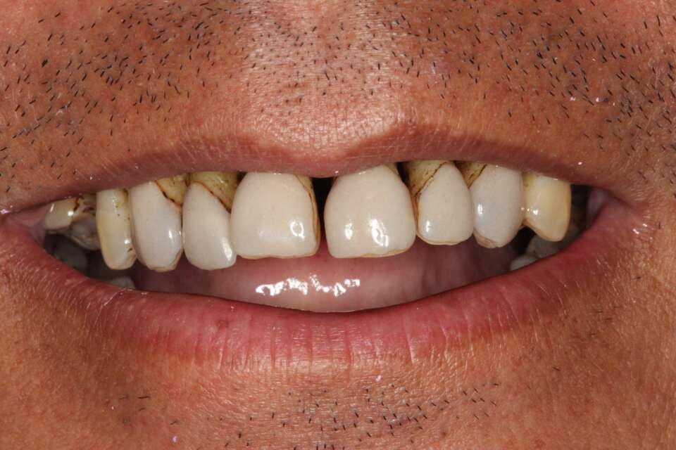 All teeth implants Before 4