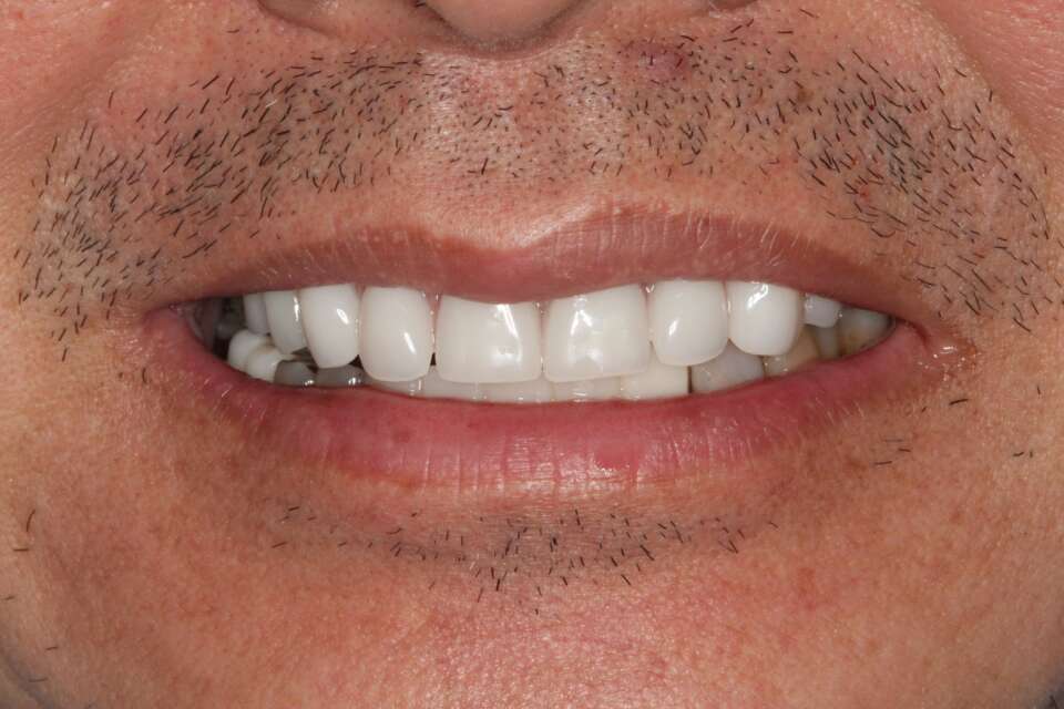 All teeth implants After 4