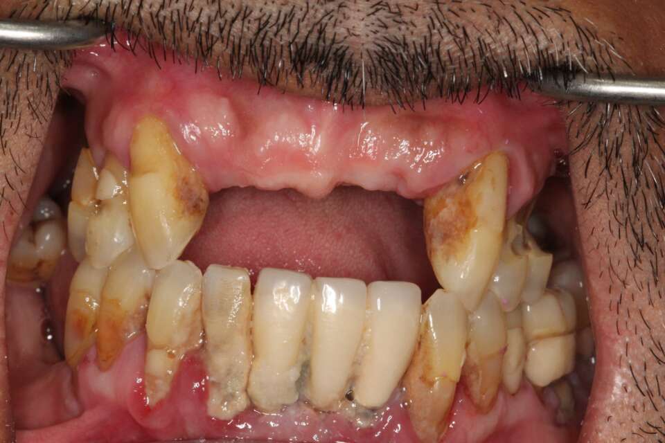 All teeth implants Before 1