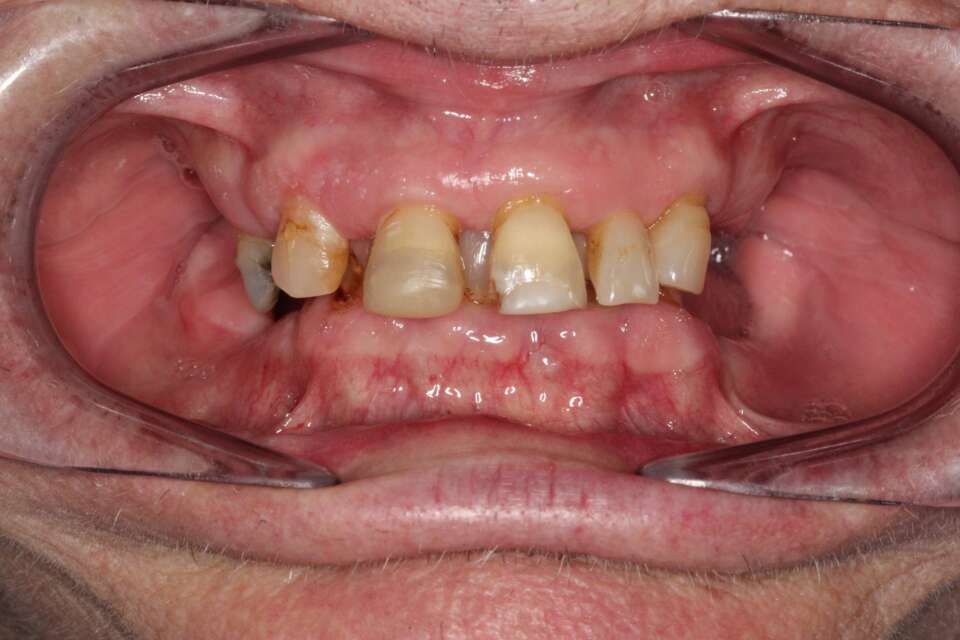 All teeth implants Before 2