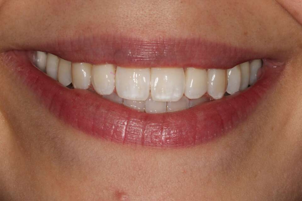 after Invisalign rotated teeth striaghtened
