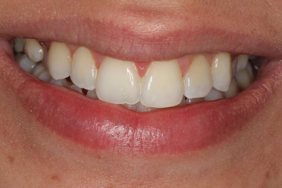 Invisalign After 2