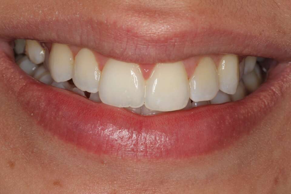 after Invisalign treatment straight teeth