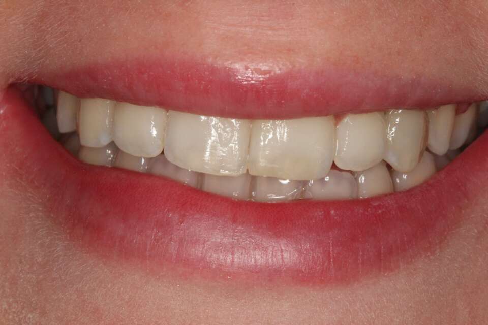 after Invisalign treatment straightened rotated teeth