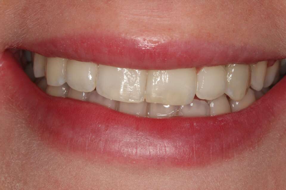 Invisalign After 3