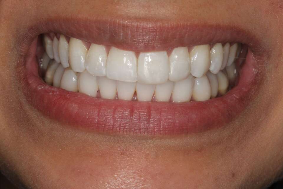 after Invisalign treatment incisor straightened