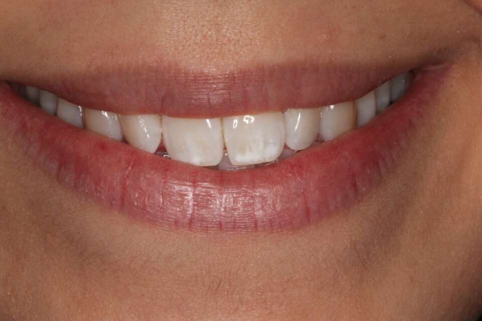 before Invisalign treatment slightly rotated teeth