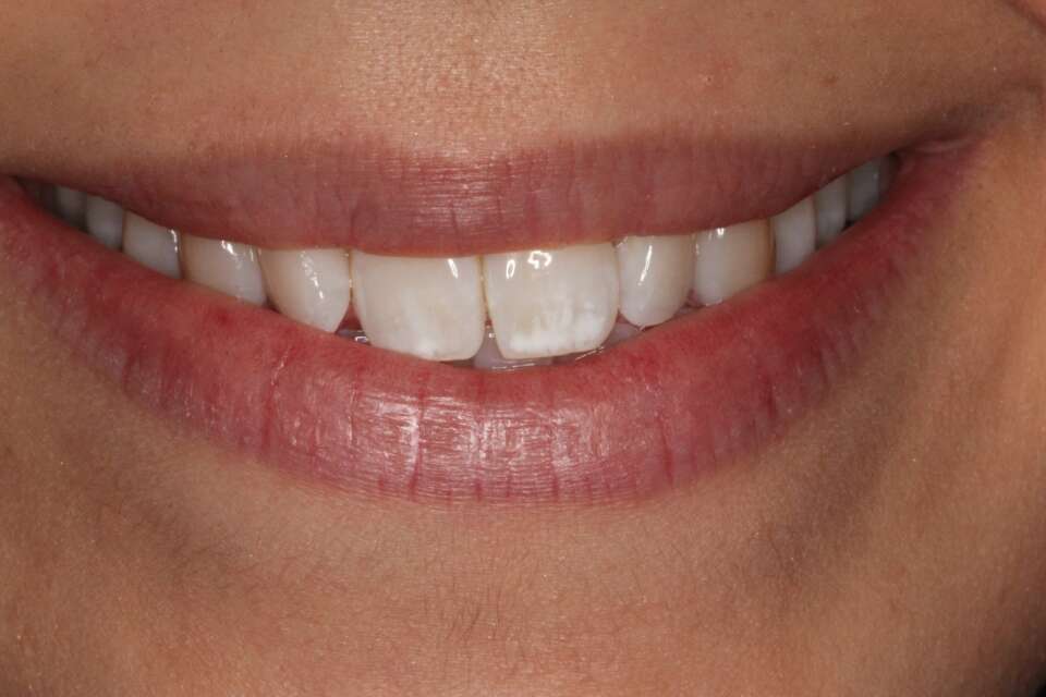 Invisalign Before 1