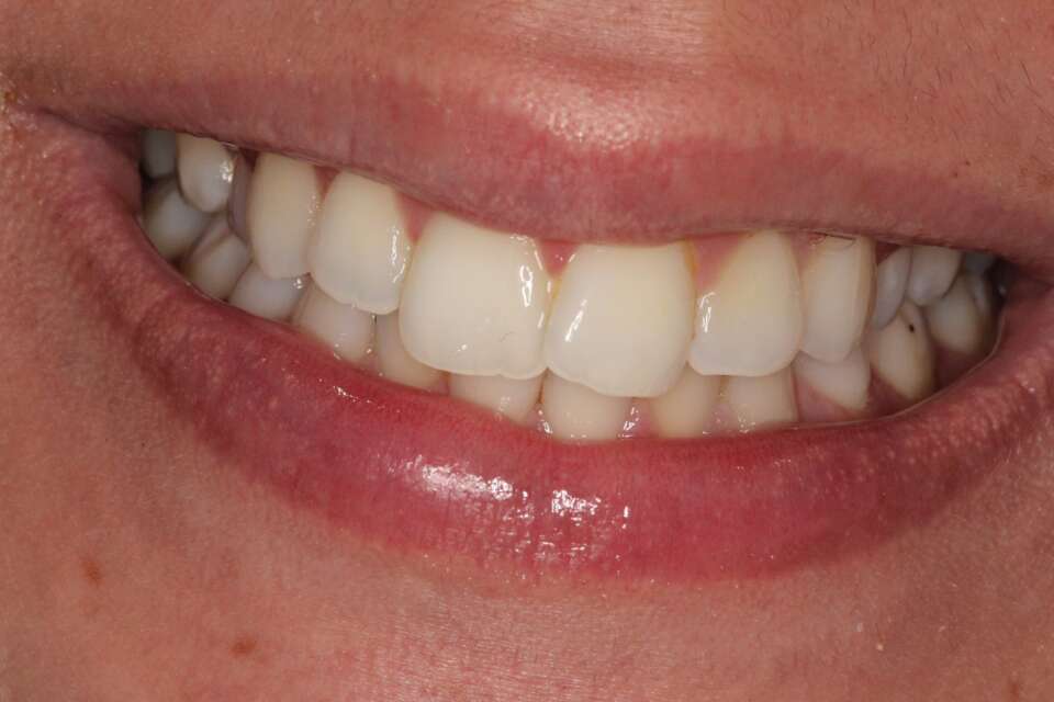 before Invisalign treatment rotated left incisor