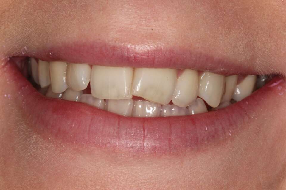 before Invisalign treatment teeth rotated