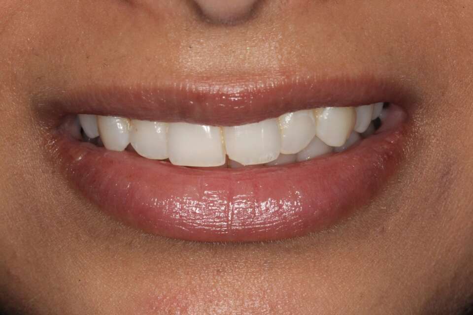 before Invisalign treatment left incisor chipped