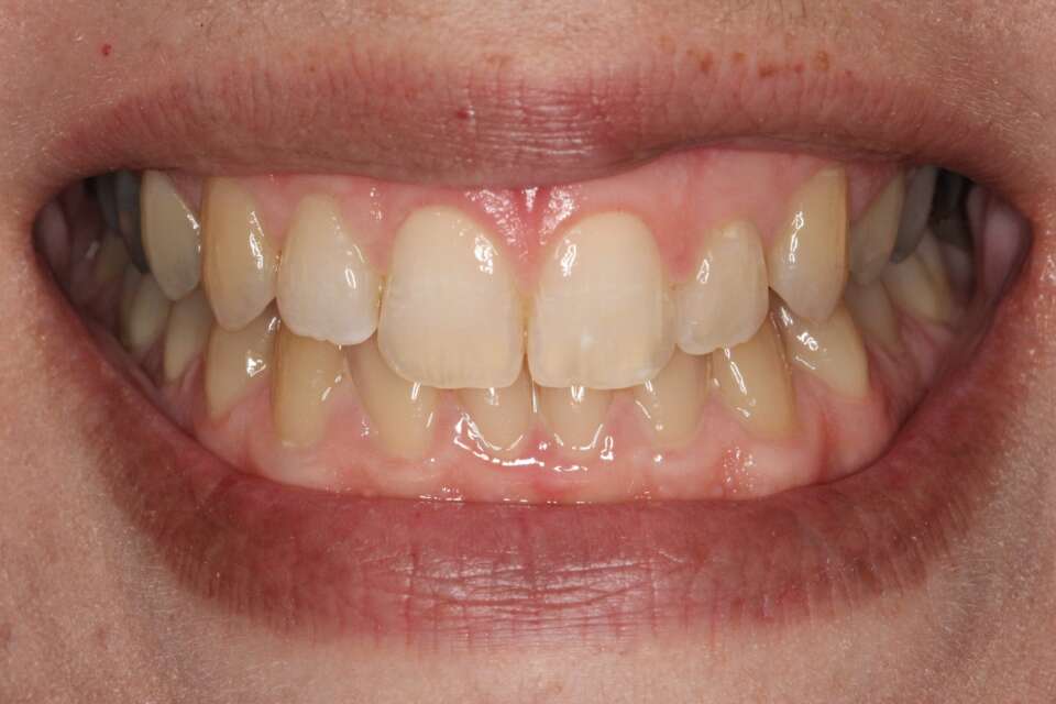 Lingual Braces After 2