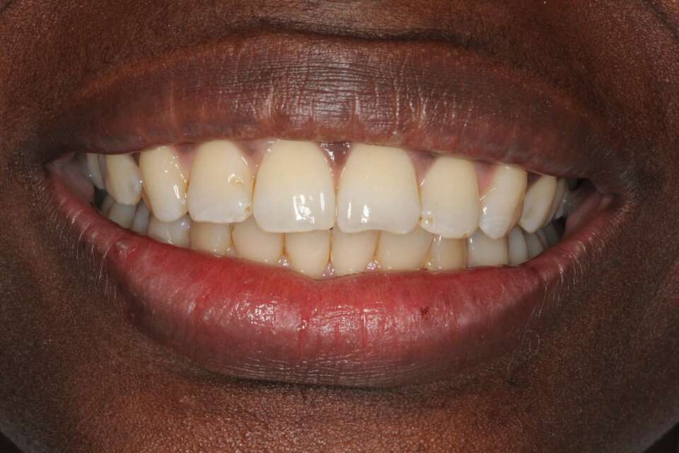 Lingual Braces After 6