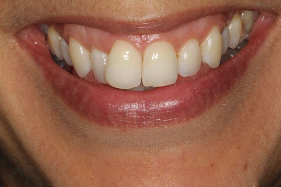 Lingual Braces Before 1