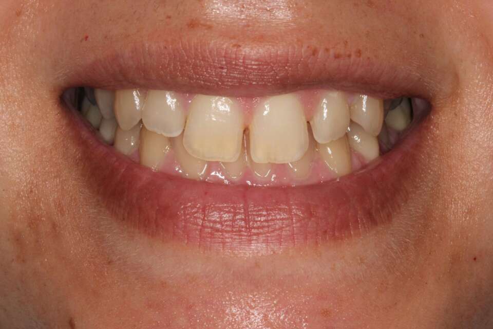 Lingual Braces Before 2