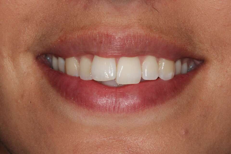 Lingual Braces Before 3