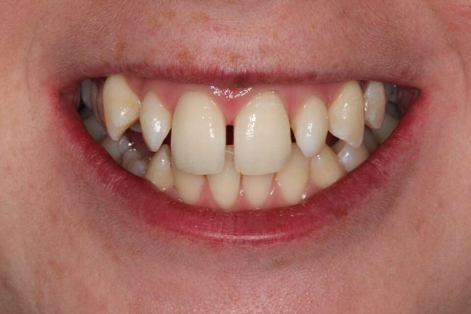 Lingual Braces Before 4