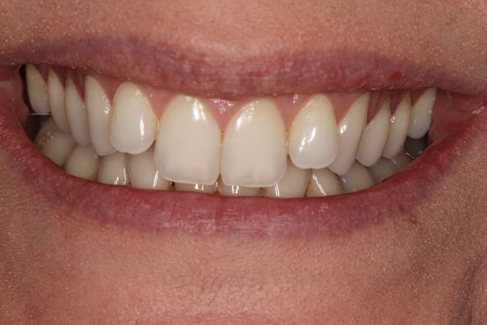 Lingual Braces Before 5