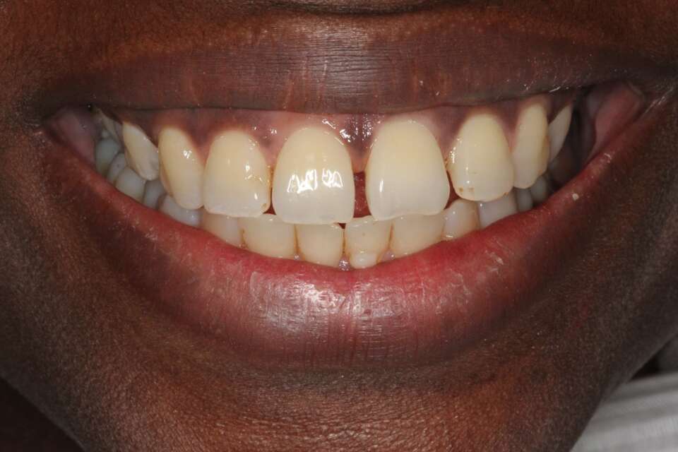 Lingual Braces Before 6