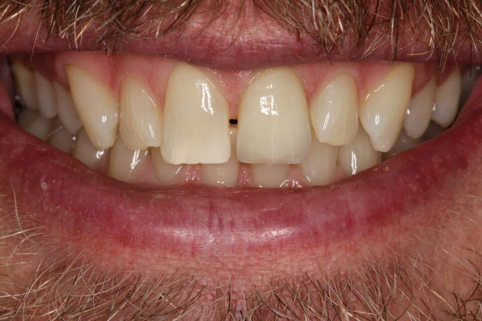 Porcelain veneers After 5