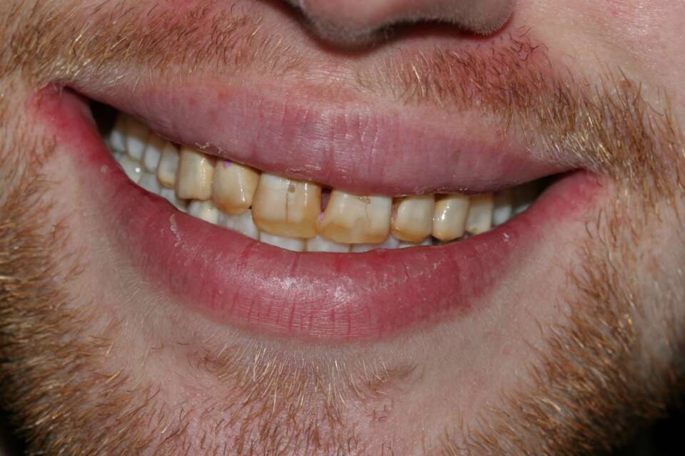 Porcelain veneers Before 6