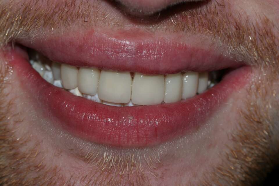 Porcelain veneers After 6