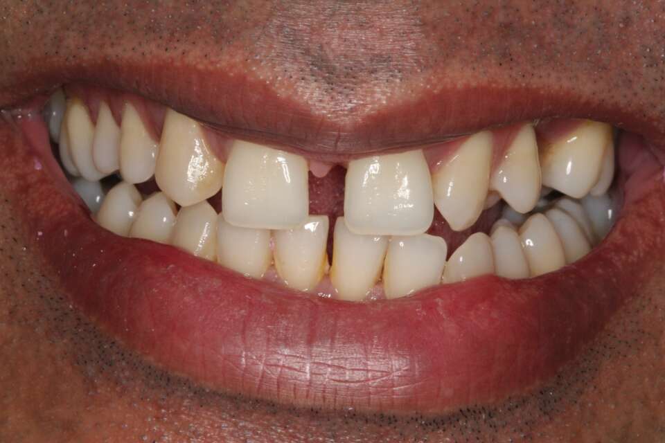 Porcelain veneers Before 1