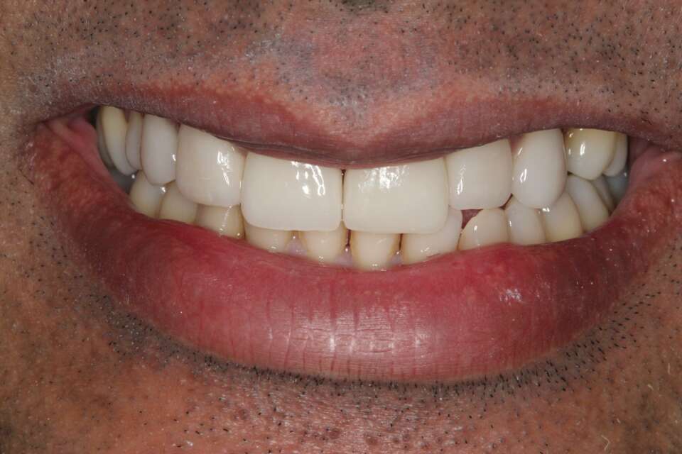 Porcelain veneers After 1