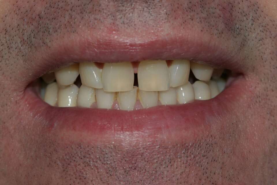 Porcelain veneers Before 2