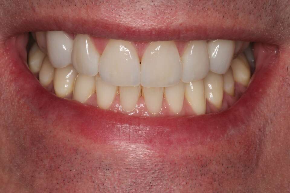 Porcelain veneers After 2