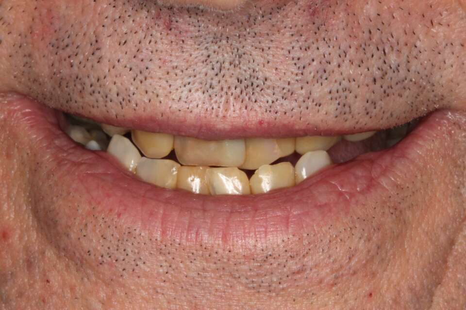 Porcelain veneers Before 3